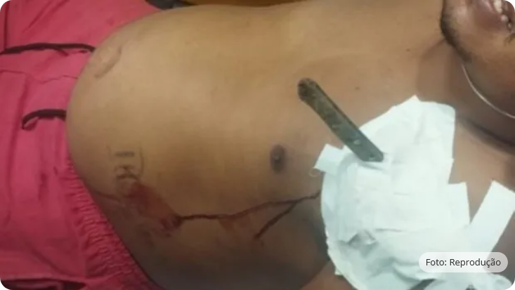 Perdoa a facada? Jovem fica com faca cravada no peito após briga com ex-companheira